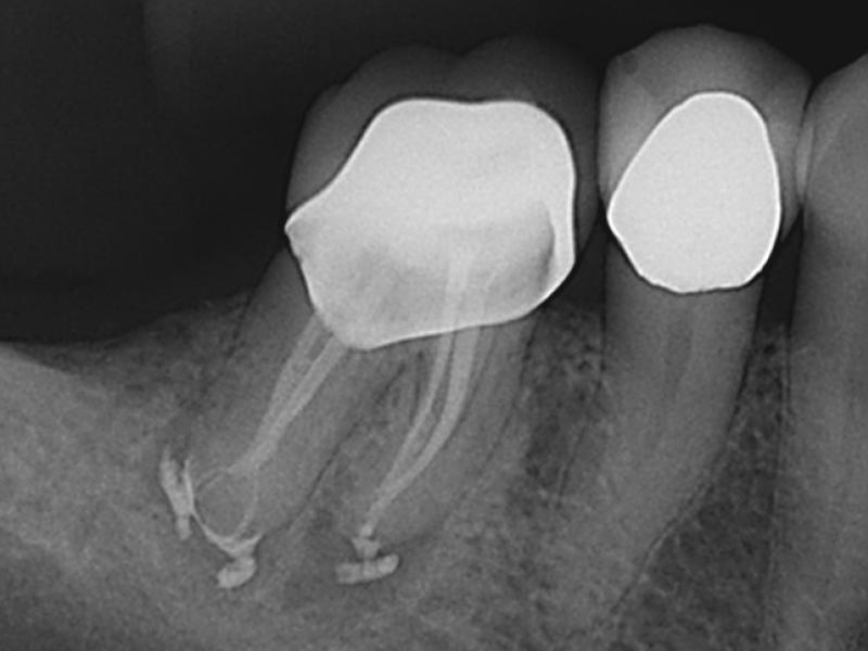 Calcified Canals with Healing Evidence